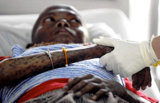 London patient cured of HIV AIDS in a medical breakthrough