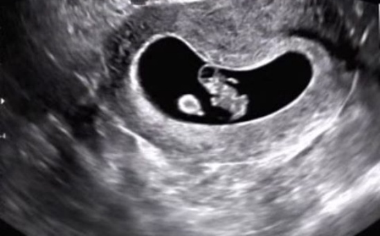 Vaginal delivery after 2 cesarean section attempts dangerous