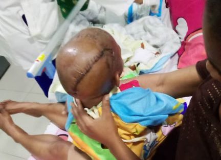 Baby viciously attacked by Pit Bulldog survives
