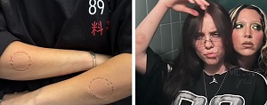 Billie Eilish Sparks Concern As She Shares Photos Of Her Arms With Bite Marks And Bruises