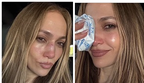 Jennifer Lopez Suffers Nasty Face Injury