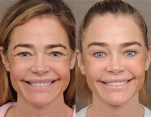 Denise Richards Before-And-After Photos Of Facelift Revealed